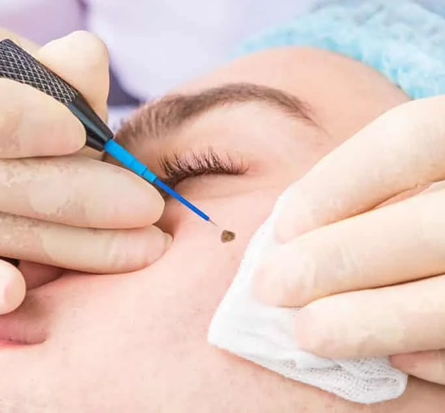 Warts / Moles / Freckles Removal