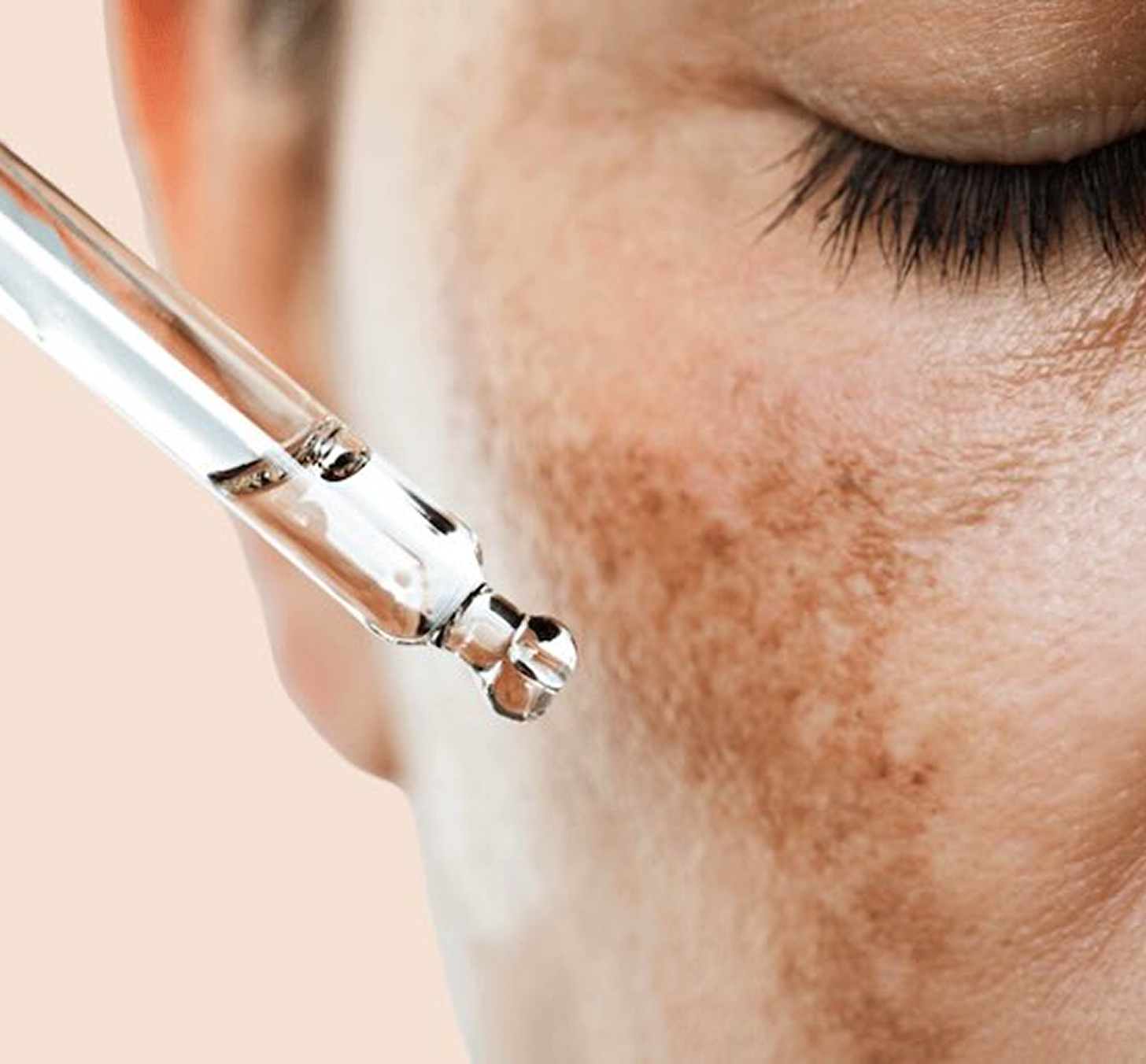 Pigmentation / Melasma Treatment