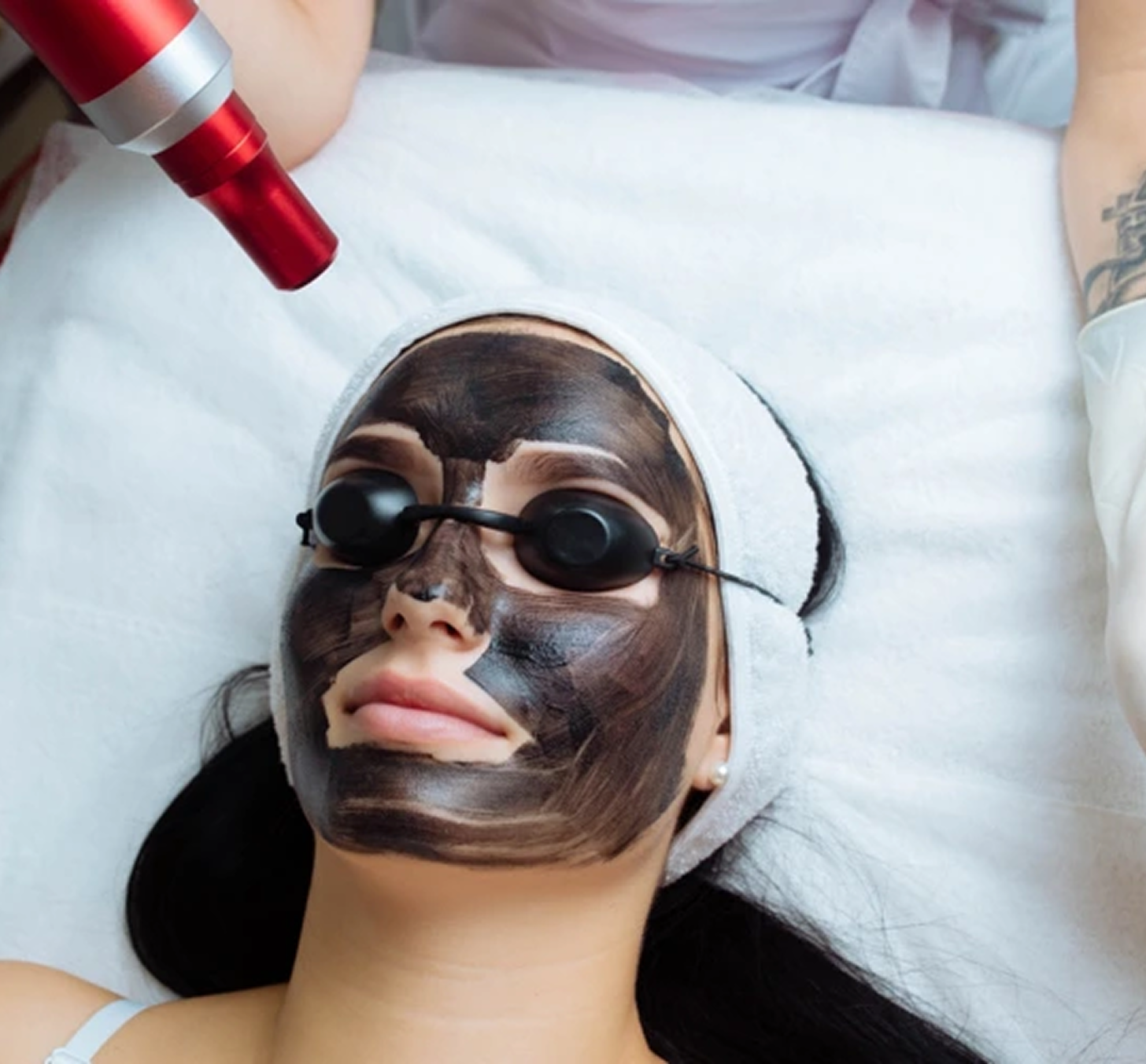 Carbon Laser Facial